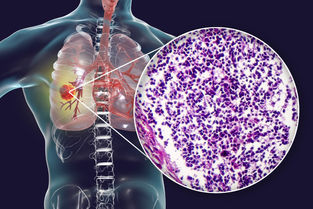 Lung cancer 3D illustration and photo under microscope of histopathology light micrograph of small cell lung cancer