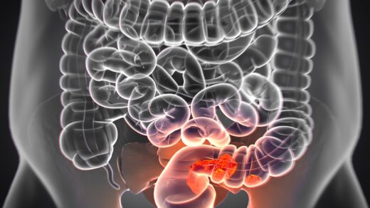 Colorectal cancer illustration