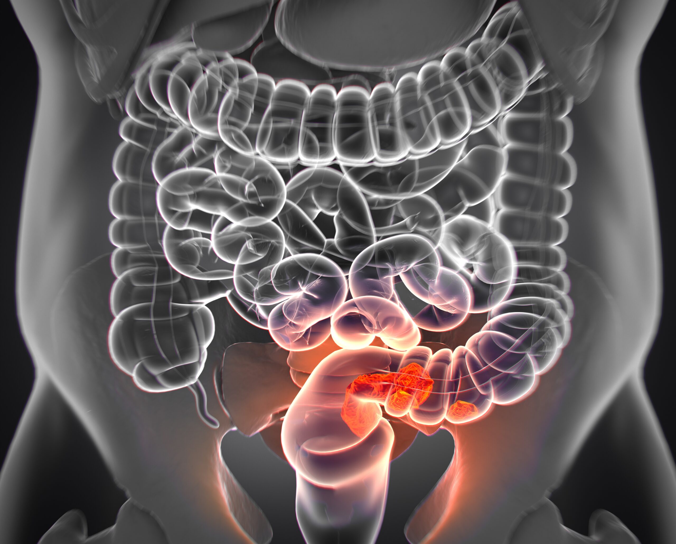 Colorectal cancer, medical anatomical illustration
