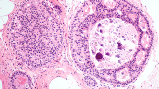 gene methylation methyl group breast cancer therapy target mechanism