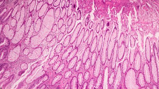 Microscopic ductal cell carcinoma. Adenonocarcinoma from human breast cancer tissue. Magnification 400X