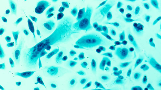 PC-3 human prostate cancer cells, stained with Coomassie blue, under differential interference contrast microscope.
