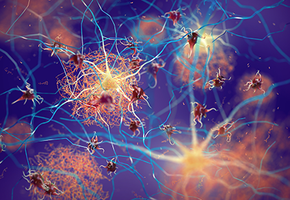 Amyloid plaques forming between neurons. Beta-amyloid protein disrupting nerve cells function in a brain with Alzheimer's disease