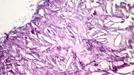 Melanoma, a cancer developing from pigment-containing cells melanocytes, light micrograph, photo under microscope