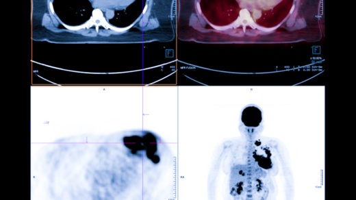 PET Scan image of whole body Comparision Axial , Coronal plane in patient breast cancer recurrence treatment.