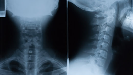 X-Ray film of neck - front and side