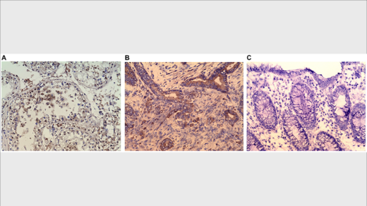 Figure 5: (A) Immunohistochemistry (IHC) staining of testis (positive control). (B) IHC staining of colonic adenocarcinoma. (C) IHC stating of Normal colonic mucosa (negative control). Purified rabbit anti-human CABYR polyclonal antibody for CABYR a/b and c antigen isoforms were used in IHC.