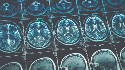 MRI or magnetic resonance image of head and brain scan.