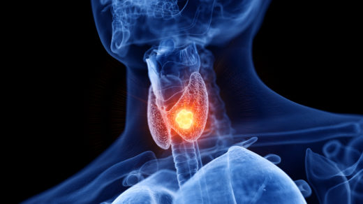 3D rendered medically accurate illustration of thyroid cancer.