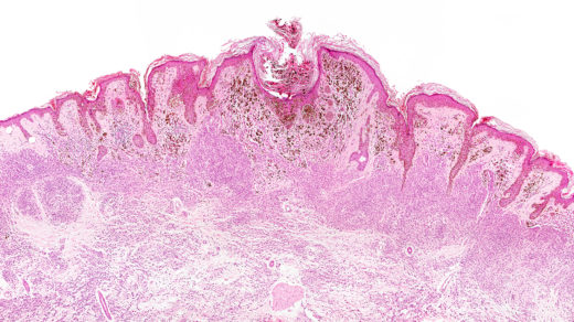 Malignant melanoma under the microscope.