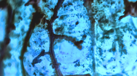 Human squamous cell carcinoma. Tissues affected by cancer cells under a microscope