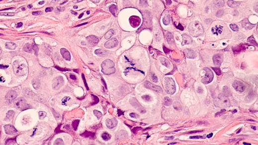 Photomicrograph of a breast cancer (grade 3 invasive ductal carcinoma) with frequent mitoses (mitotic figures), including a large central atypical mitoses.