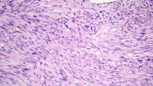 Leiomyosarcoma, a malignant cancerous smooth muscle tumor, light micrograph, photo under microscope