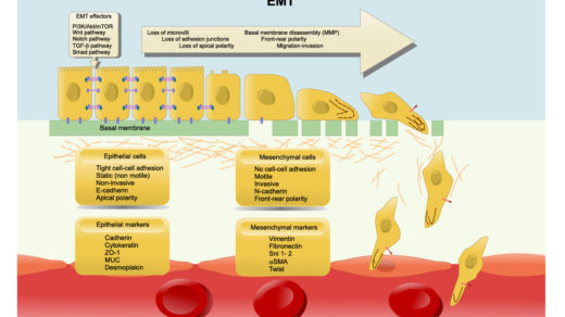 epithelial–mesenchymal transition (EMT): losing cell polarity and cell adhesion to gain migratory and invasive properties.