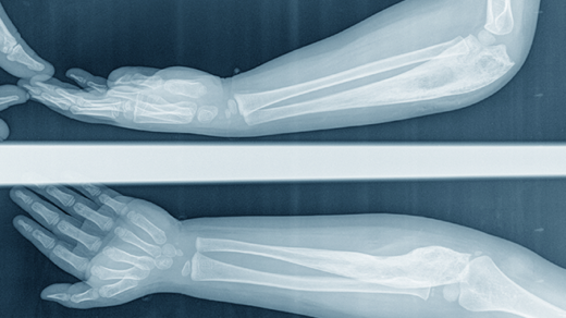 A child x-ray elbow ​Lateral, AP view of the forearm caused by bone cancer(osteosarcoma) of the ulna.