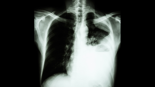 Lung cancer x-ray