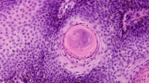 Keratin pearl found in a papilloma of the larynx. It is a keratinized structure found in regions where abnormal squamous cells form concentric layers.