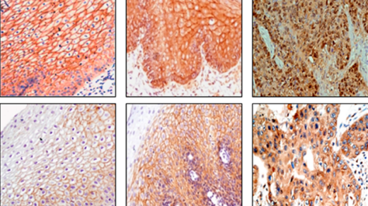 (Rotated) Figure 1: Immunohistochemical analysis of Wnt protein in esophageal tissues.
