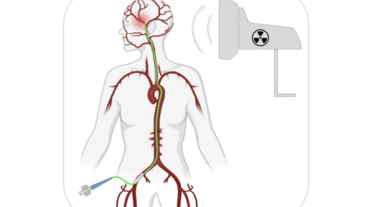Figure 1: A transfemoral path to BBB opening.