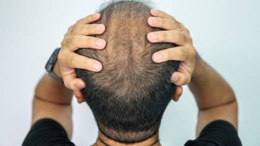 Can Mechanisms of Hair Loss Shed Light on Cancer and Aging?
