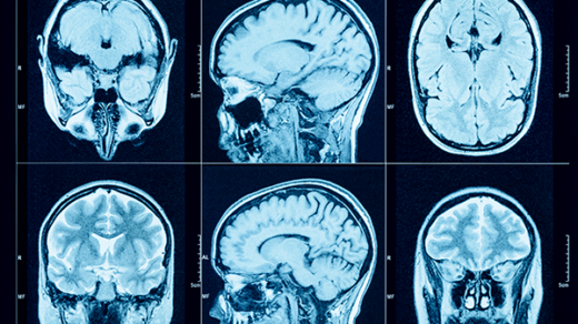 New Drug May Boost Effectiveness of Glioblastoma Treatment