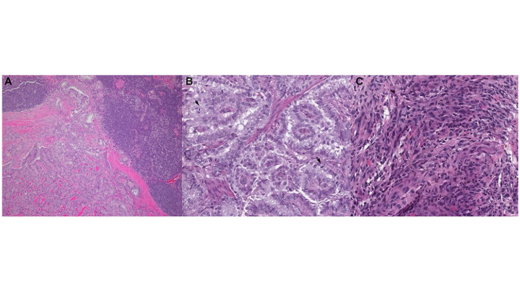 Genetic Alterations in Thyroid Cancer: Resistance to BRAFi and Anaplastic Transformation