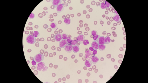 Synergistic Effects of Drug Combinations Targeting AML Cells