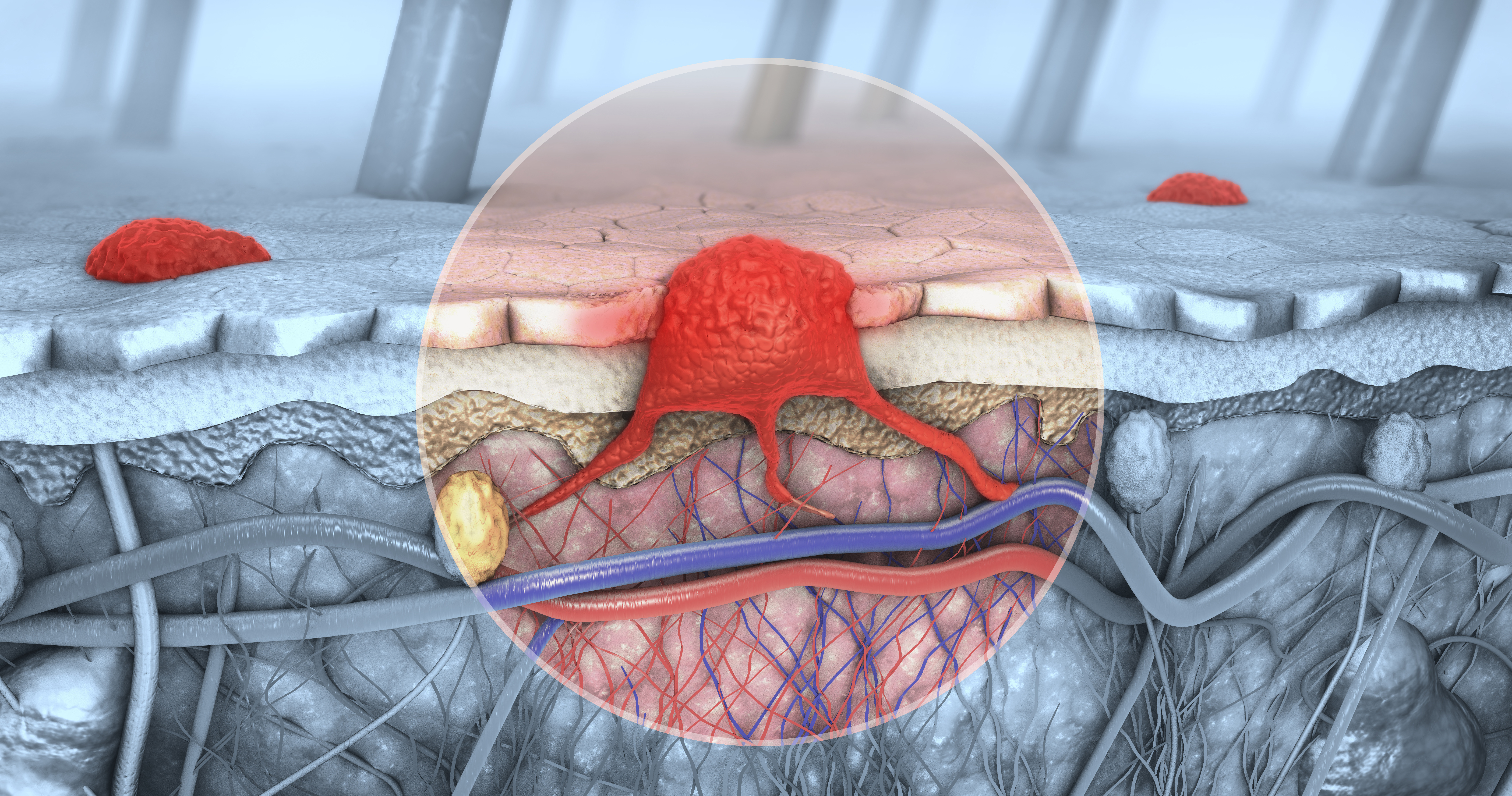 Melanoma