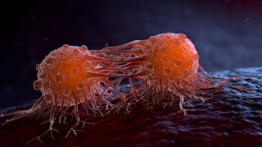 breast cancer