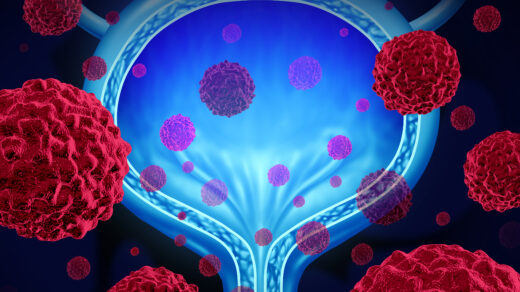 Bladder Cancer