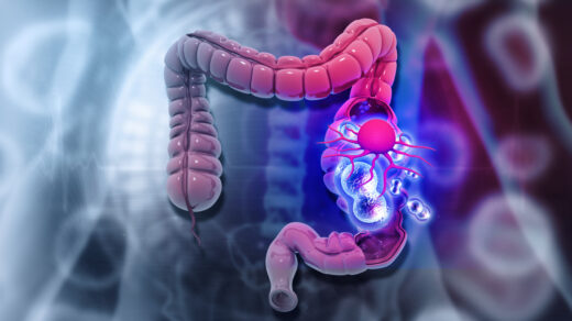 Human colon cancer. 3d illustration