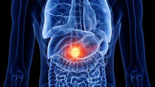 3d rendered medically accurate illustration of pancreas cancer