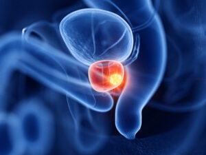 3d rendered medically accurate illustration of prostate cancer