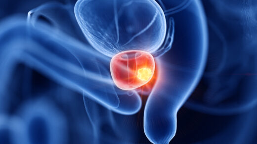 3d rendered medically accurate illustration of prostate cancer