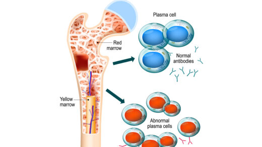 Multiple myeloma. plasma cell myeloma